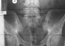 twisted pelvis x-ray